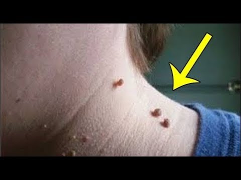 لايف ستايلوصفة بسيطة للتخلص من الزوائد الجلدية83151/0