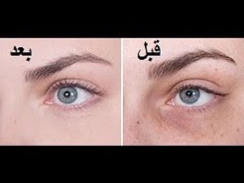 لايف ستايلطريقة سريعة للتخلص من الهالات السوداء83713/0