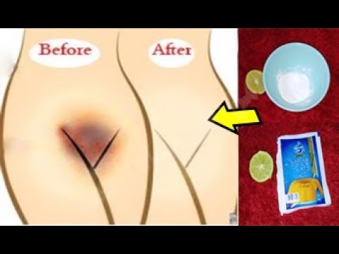 لايف ستايلشاهد: تبييض المناطق الحساسة في5 دقائق85031/0