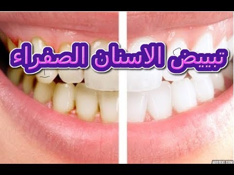 لايف ستايلشاهد: وصفة مذهلة لتبييض الأسنان وإزالة الاصفرار85807/0