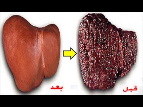 لايف ستايلشاهد| وصفة أدهشت الأطباء تمكنك من تنظيف الكليتين فورًا86354/0