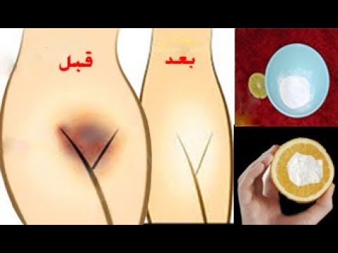 لايف ستايلشاهد| وصفة مُجربة لتبييض المناطق الحساسة بين الفخذين في 5 دقائق86355/0