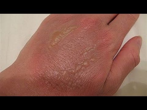 لايف ستايلشاهد: طريقة التصرّف مع الحروق في المنزل86358/0