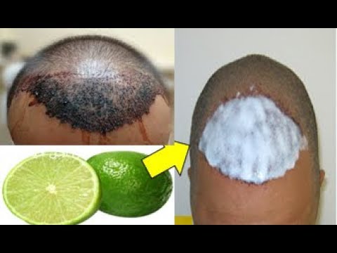 لايف ستايلشاهد: حبة ليمون واحدة فعالة لإنبات فراغات الشعر وعلاج الصلع86371/0