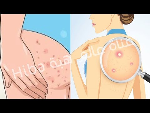 لايف ستايلشاهد: أسباب ظهور الحبوب على الظهر والمؤخرة87561/0