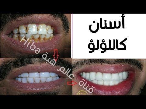 لايف ستايلشاهد| خلطات طبيعية لتبييض الأسنان خلال دقائق فقط89538/0