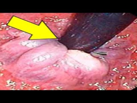 لايف ستايلشاهد: طريقة لعلاج البواسير دون جراحة90443/0