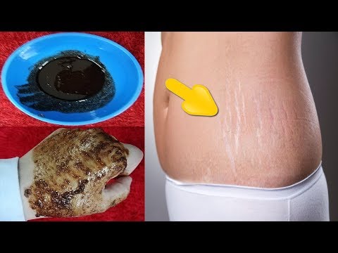 لايف ستايلشاهد: طريقة لإزالة آثار التخسيس من الجسم90445/0