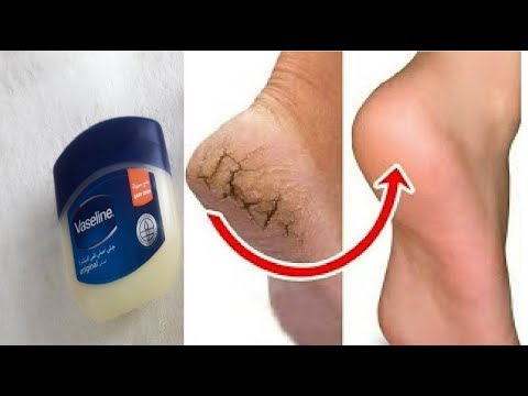 لايف ستايلشاهد: طريقة رائعة  للتخلص من تشقُق القدمين 92209/0