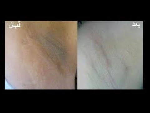 لايف ستايلوصفة مذهلة تقضي على الإسمرار في 5 دقائق92414/0