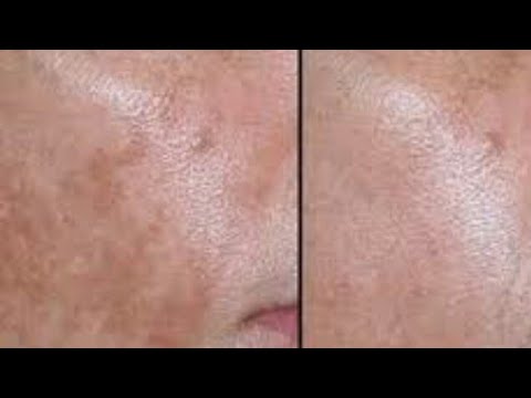 لايف ستايلخلطة تساعد على إزالة الكلف والبقع الداكنة92417/0