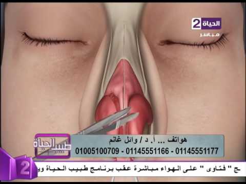 لايف ستايلشاهد: طريقة إجراء عملية جراحة تجميل الأنف15846/0