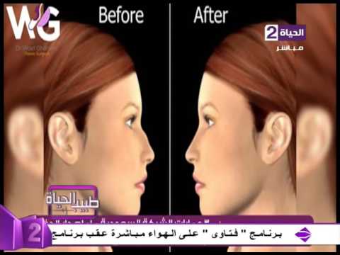 لايف ستايلشاهد: شرح مفصّل للعملية الجراحيّة التجميليّة للأنف15847/0