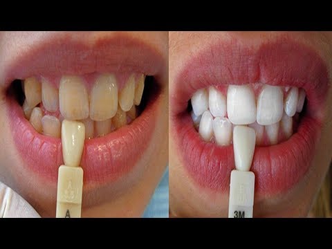 لايف ستايلشاهد: طريقة لتبييض الأسنان بسهولة93931/0
