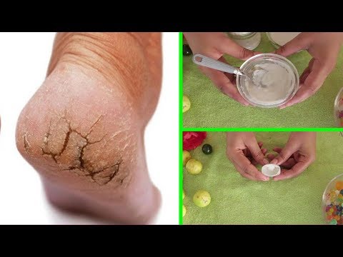 لايف ستايلخليط لعلاج تشققات الأقدام نهائيا93933/0