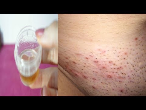 لايف ستايلمحلول يقي البثور بعد إزالة شعر العانة94713/0