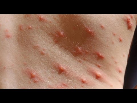 لايف ستايلشاهد علاج سهل لمرض الجدري بجنيه94827/0