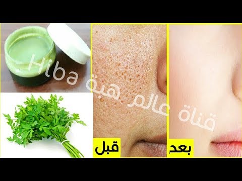 لايف ستايلحزمة بقدونس تخلصك من المسام الواسعة95268/0