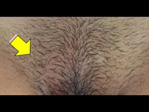 لايف ستايلشاهد: طريقة مُجربة لإزالة شعر العانة نهائيًا95293/0