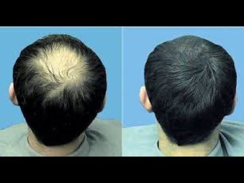 لايف ستايلطريقة فعّالة لوقف تساقط الشعر ولنموه95338/0