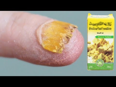 لايف ستايلطريقة لعلاج فطريات الأظافر95339/0