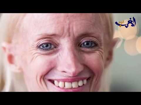 لايف ستايلشاهد : أميركية "تسبق عمرها" بـ8 مرات بسبب "بنجامين باتون"123176/0