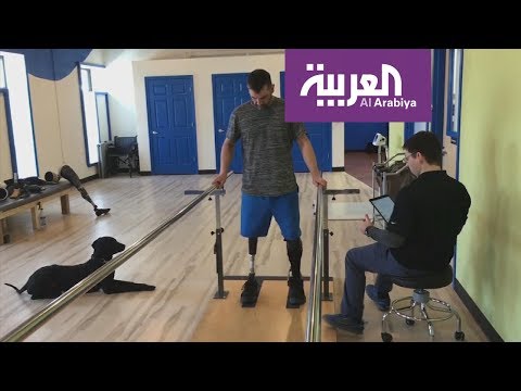 لايف ستايلشاهد: تطوير جهاز جديد يخفف آلام ذوي الأطراف المبتورة129227/0