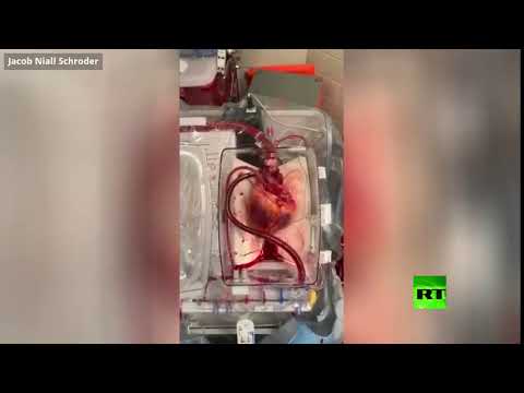 لايف ستايلشاهد: إعادة قلب "ميت" إلى الحياة للمرة الأولى في تاريخ الولايات المتحدة152062/0