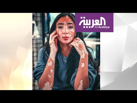 لايف ستايلشاهد: مدونة مصرية حولت إصابتها بالبهاق إلى نجاح153679/0