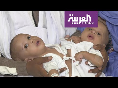 لايف ستايلشاهد: التوأم السيامي رقم 108 يصل إلى السعودية لبحث إجراء عملية الفصل157158/0