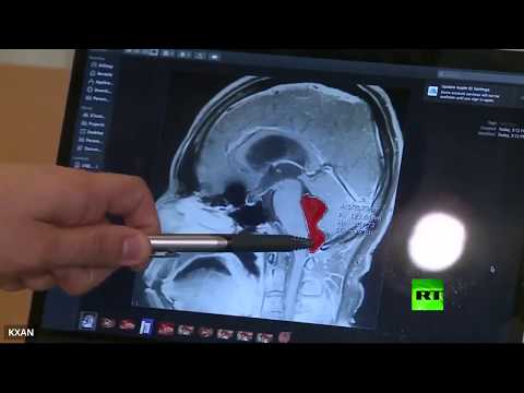 لايف ستايلشاهد: اكتشاف دودة شريطية في دماغ أميركي162423/0