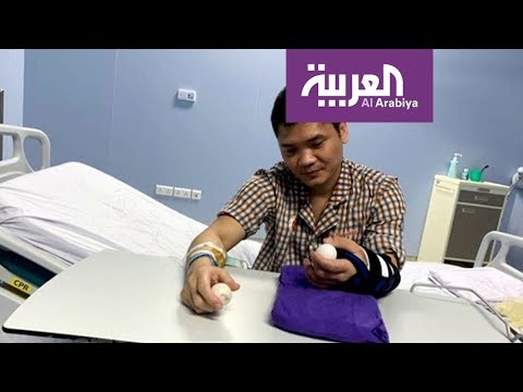 لايف ستايلشاهد: نجاح أول عملية جراحية لزرع كف من متبرع حي166476/0