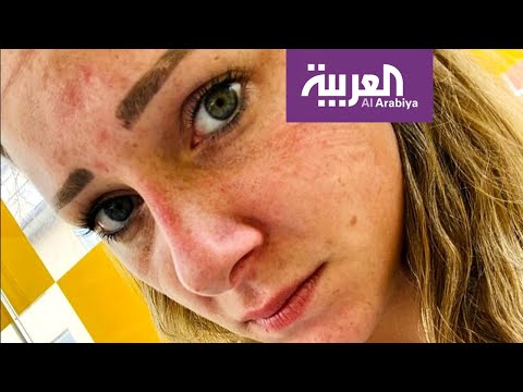 لايف ستايلشاهد: "كورونا" يترك آثاره على وجوه الطواقم الطبية في إيطاليا170380/0