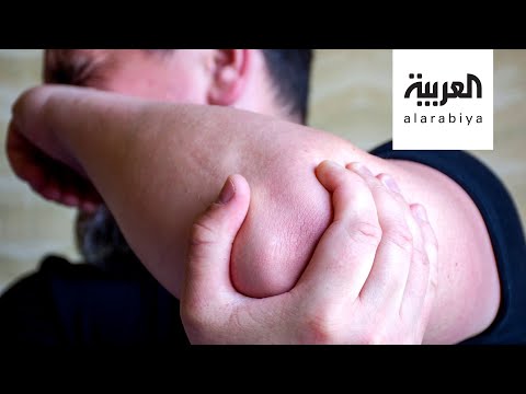 لايف ستايلشاهد: كيف تتعامل مع الكسور في ظل "كورونا"؟178062/0