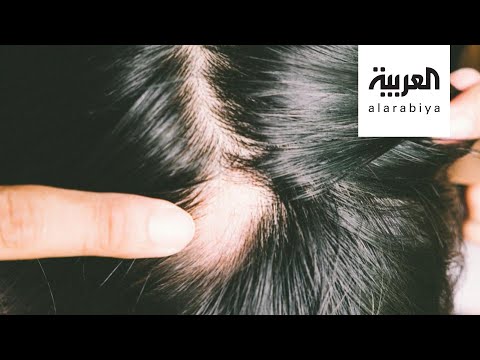 لايف ستايلشاهد: القلق والتوتر قد يؤديان لظهور ثعلبة الشعر191006/0