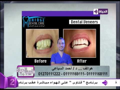 لايف ستايلشاهد: نتائج مُبهرة بعد تجميل الأسنان17774/0