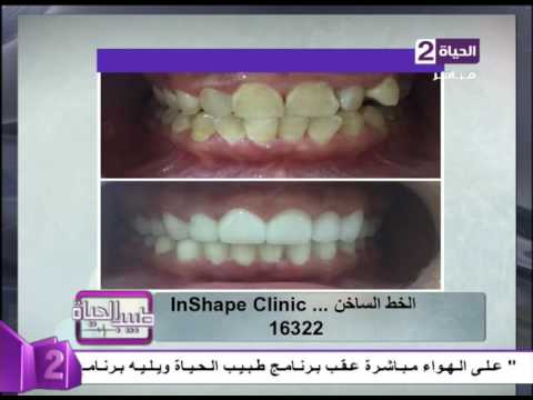 لايف ستايلبالفيديو : نتائج مبهرة بعد عملية تجميل الأسنان19574/0