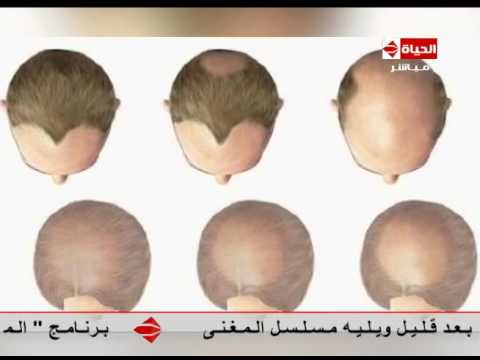 لايف ستايلمرض الثعلبة ومدى خطورتها وكيفية علاجها21948/0