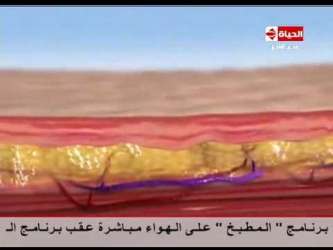 لايف ستايلشاهد: فيديو يوضح كيف يعمل الليزرعلى تفتيت الدهون25509/0