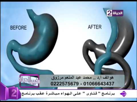 لايف ستايلشاهد: فيديو لعملية تحويل المسار للمعدة25512/0