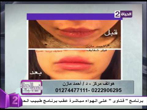 لايف ستايلشكل الشفايف بعد حقنها بالفيلر25777/0