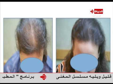 لايف ستايلبالفيديو: نتائج مبهرة بعد علاج "الصلع الوراثي"28116/0