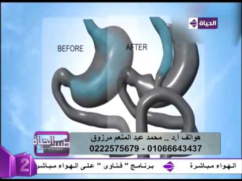 لايف ستايلبالفيديو: تفصاصيل عملية تحويل المسار المصغر ومضاعفاتها32735/0