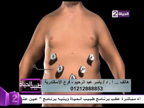 لايف ستايلشاهد: طريقة إعداد كيف تتم عملية تكميم المعدة33916/0