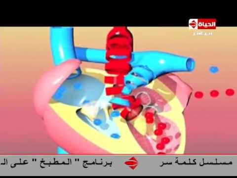 لايف ستايلشاهد: مقطع لثقب في القلب عند الأطفال وكيفية علاجه33920/0