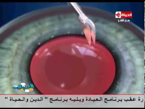 لايف ستايلشاهد: فيديو لحالة تجري عملية إزالة المياه البيضاء37633/0