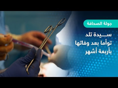 لايف ستايلشاهد: سيدة تلد توأمًا بعد وفاتها بأربعة أشهر في البرازيل37705/0