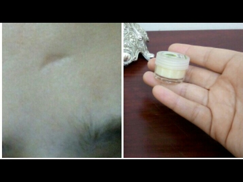 لايف ستايلشاهد: دهان عجيب يخلص من حفر الوجة41683/0