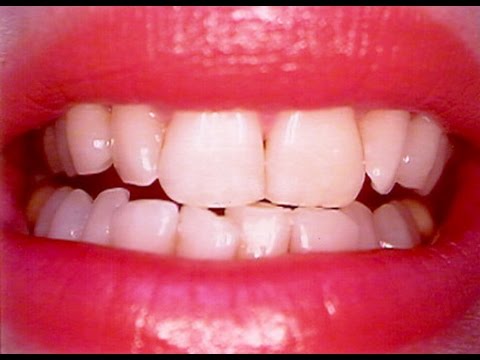 لايف ستايلشاهد: خلطة عجيبة لتبييض الأسنان في 10 دقائق41777/0