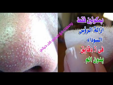 شاهد وصفة سحرية لازالة الرؤوس السوداء بفعالية كبيرة